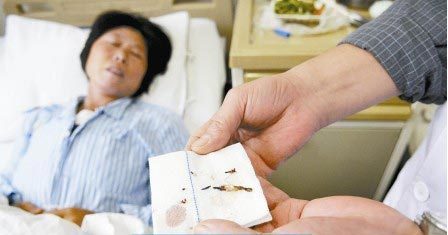 通過手術(shù)取出的針?！　∩虉笥浾?