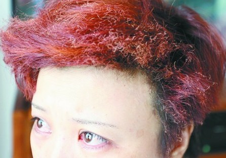 張女士的頭發(fā)、眉毛被燒。