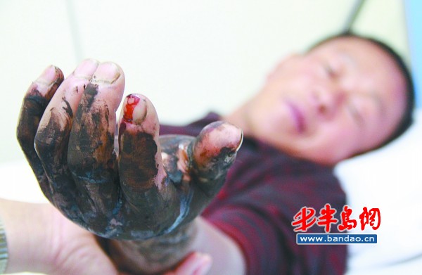 鄒先生的左手被蛇咬傷后明顯腫脹。