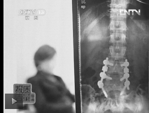 圖1：教練按壓導(dǎo)致學(xué)員腰椎間盤突出。（央視截屏）