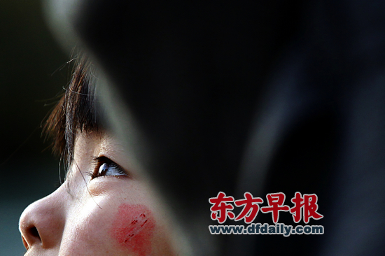 昨日，復(fù)旦大學(xué)附屬兒科醫(yī)院，7歲女童若若（化名）左邊臉頰還留有被劃破的傷痕。 早報記者 王辰 圖