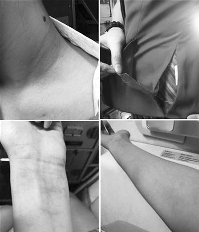 南航一空姐被打后，稱(chēng)其手部淤青，身上有多處撓痕。