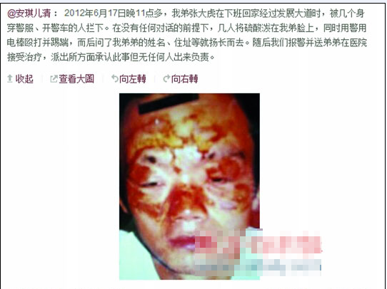 張大虎的姐姐將弟弟面部燒傷一事發(fā)上微博，引發(fā)網(wǎng)友廣泛關(guān)注。
